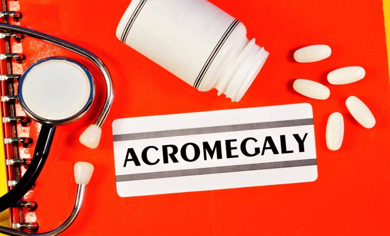 Akromegalia