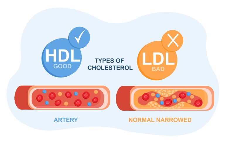 cholesterol HDL o LDL