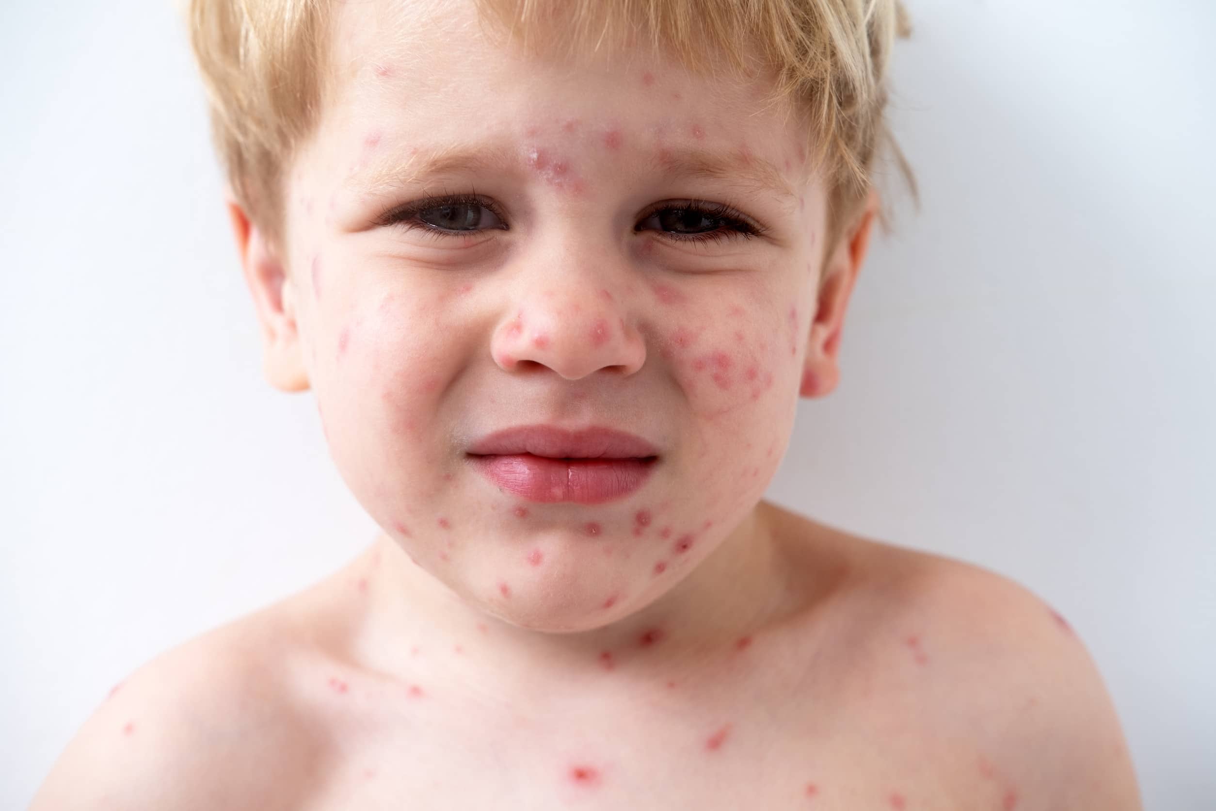 Alergia skórna u dzieci