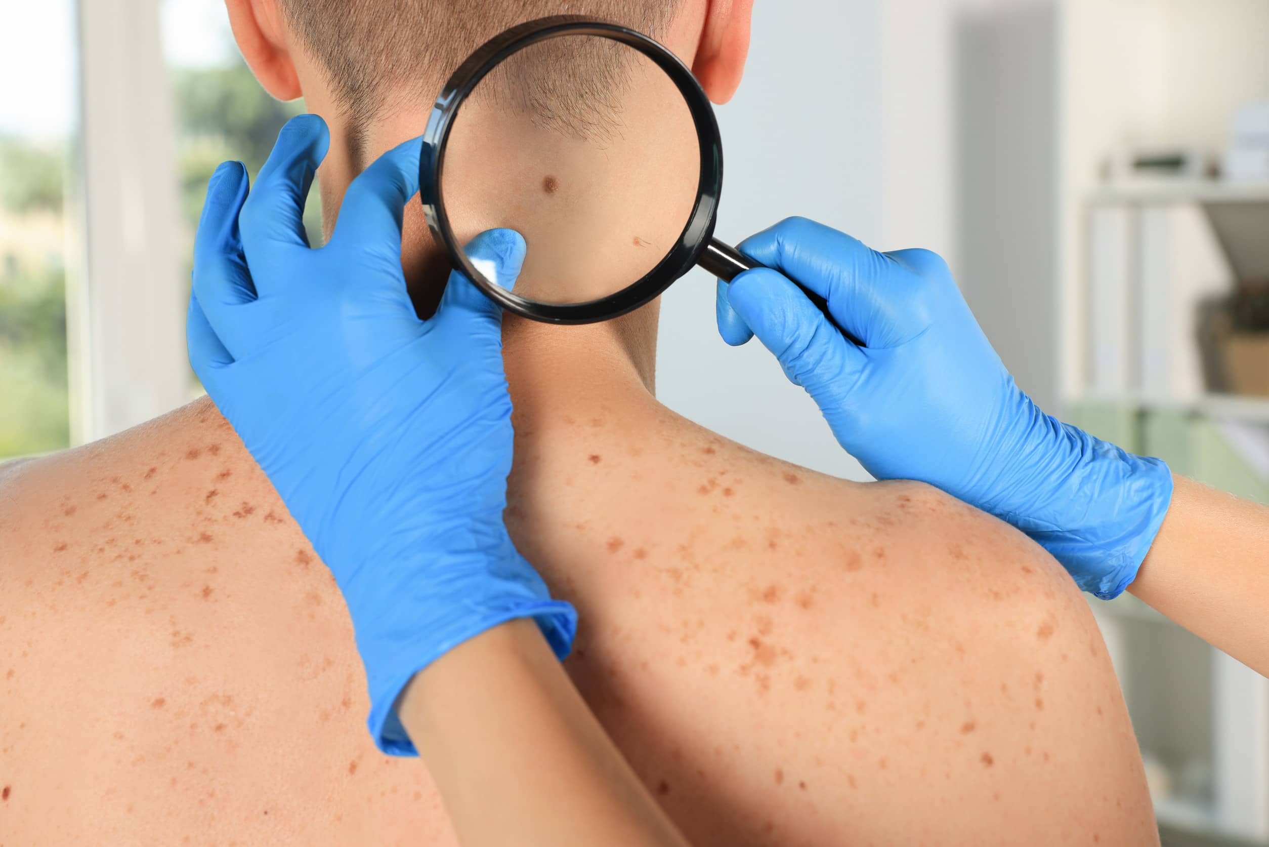 badanie dermatologiczne