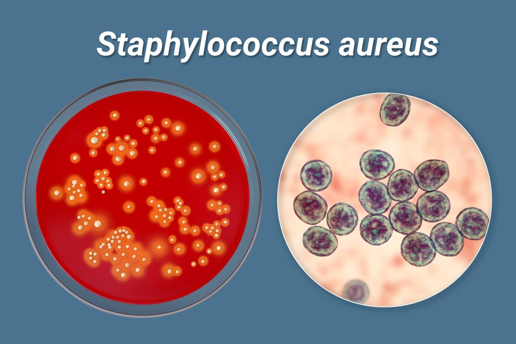 Staphylococcus aureus