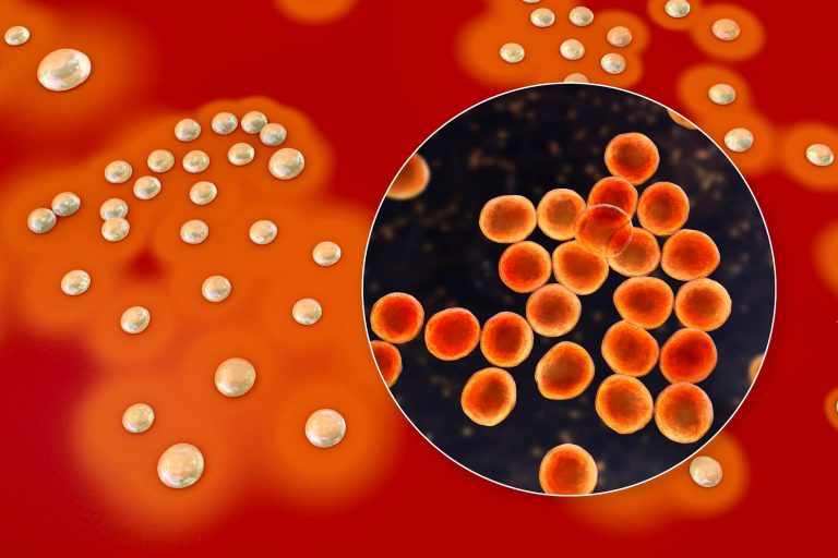Gronkowiec złocisty (Staphylococcus aureus) - objawy, leczenie i zapobieganie zakażeniom
