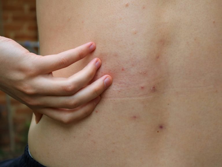 podrogowa krostkowa dermatoza