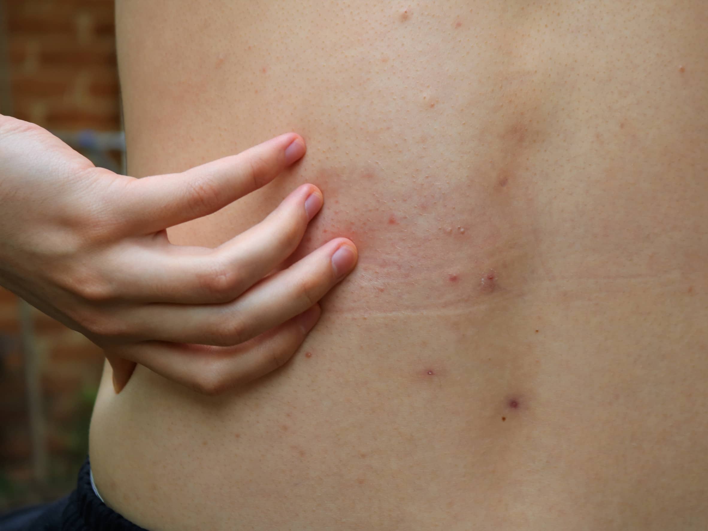 podrogowa krostkowa dermatoza