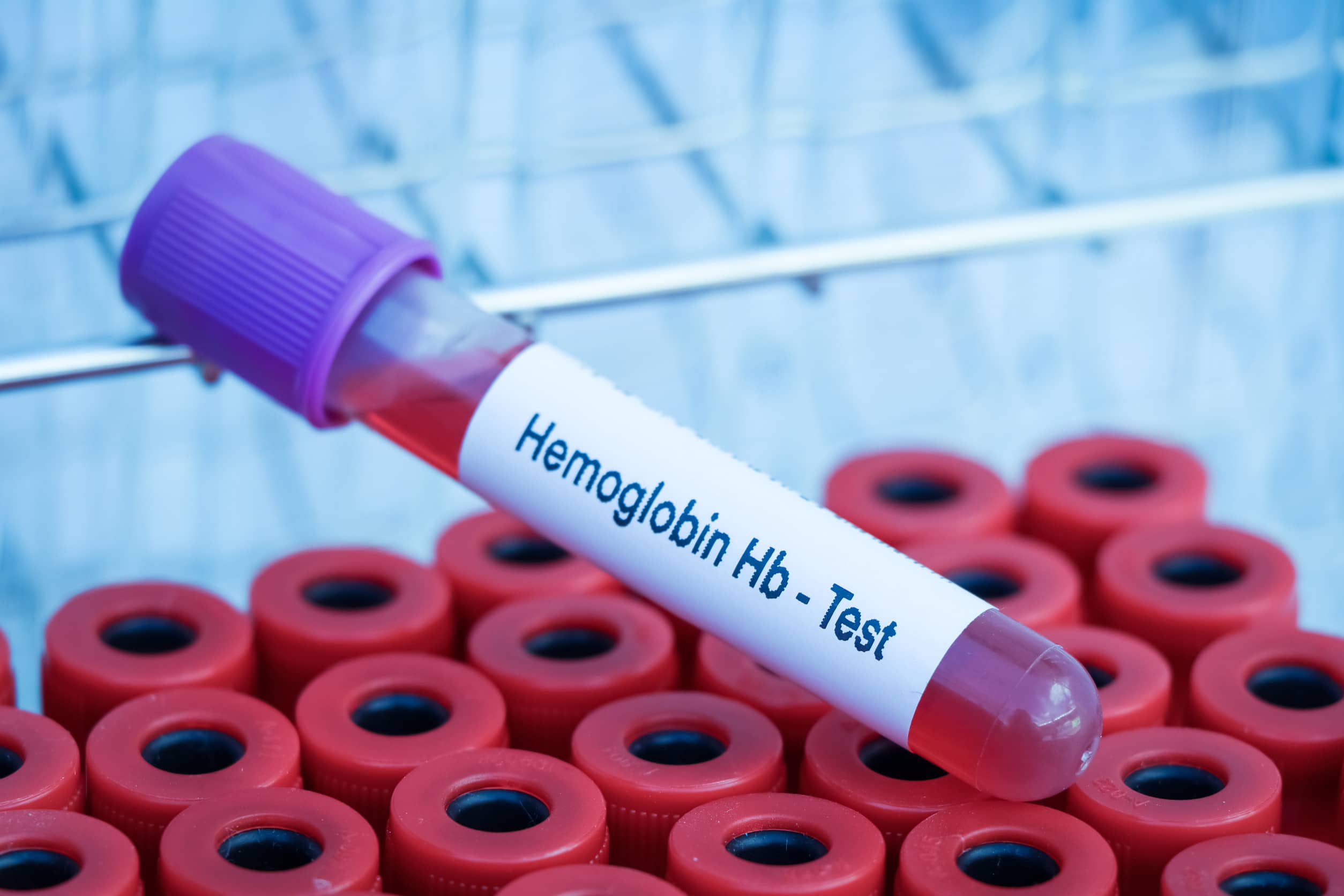 badanie poziomu hemoglobiny