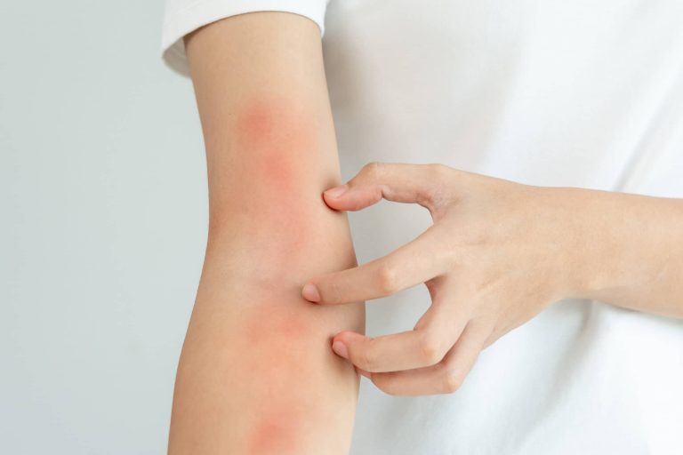 alergiczne reakcje skórne