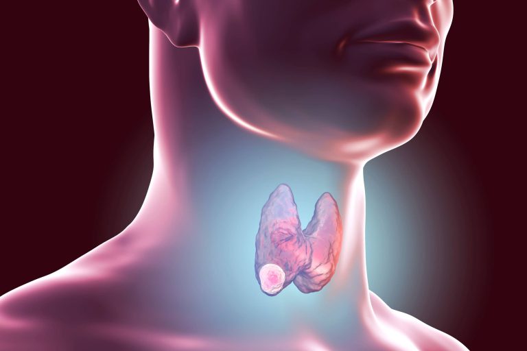 Nadczynność tarczycy